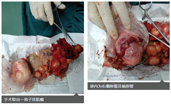 【子宫肌瘤】腹腔镜下子宫全切术成功实施,取出子宫肌瘤一串串
